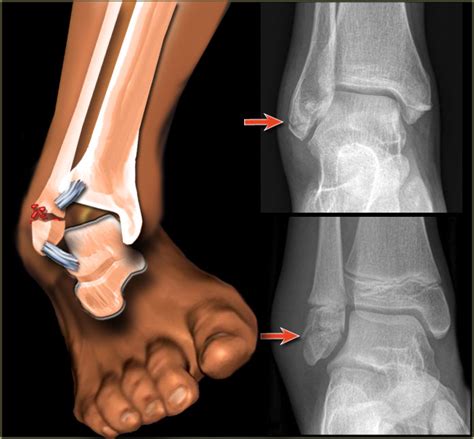 The Radiology Assistant Ankle Fractures Weber And Lauge Hansen Classification