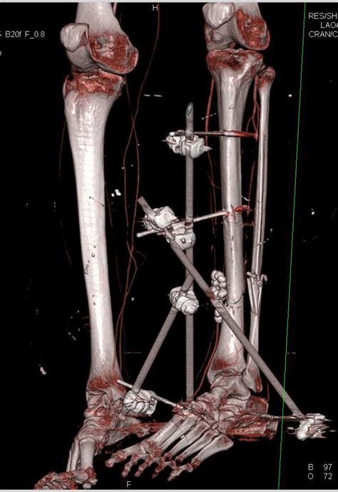 Tibia And Fibular Fractures With Open Reduction Internal Fixation Orif