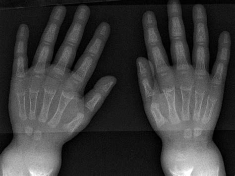 Britains Oldest Case Of Rickets Found In 5000 Year Old Skeleton