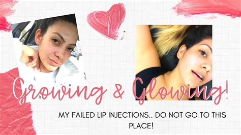 When lip fillers go wrong. Lip fillers gone wrong - TIPS IF YOUR PLANNING ON FILLERS ...