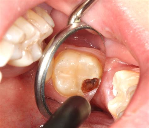 Karies (zahnfäule) ist ein prozess, bei dem sich die zahnhartsubstanz langsam abbaut und schließlich ein loch im zahn entsteht. Karies an dem letzten Zahn ganz hinten | Zahnnotizen