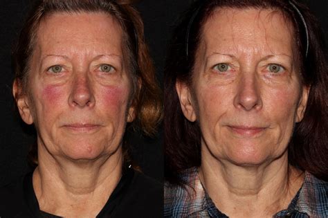 Halo® Skin Rejuvenation Before And After Pictures Case 41 Chico Yuba