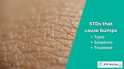 Stds That Cause Bumps In Men And Women Symptoms And Treatment