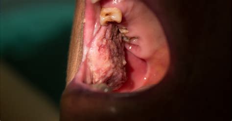 Primary syphilis typically has one or more sores at the original site of infection that are usually firm, round, and painless. Facts about Syphilis Oral Lesions | TLC Women's Center
