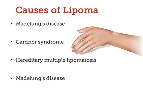 Lipoma Symptoms Causes Treatment And Cost