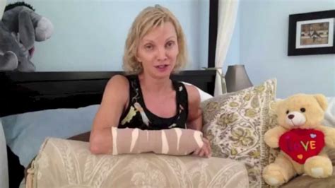 Basal Joint Arthritis Cmc Surgery Days After Surgery Youtube