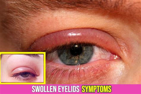 What Causes Swollen Eyelids Symptoms You Shouldnt Ignore