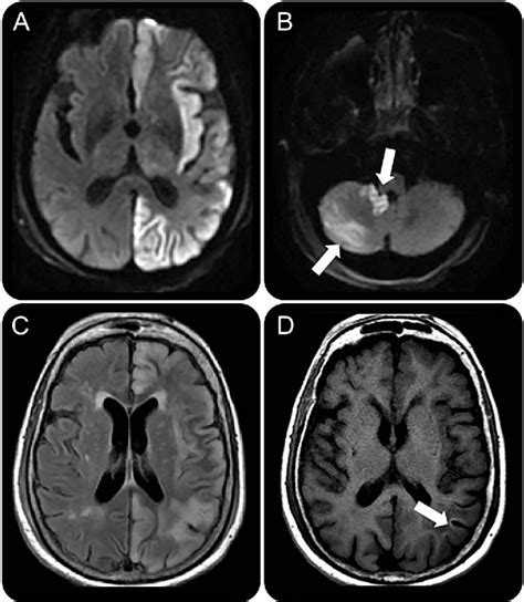 Figure 1 From Teaching Neuroimages Acute Crossed Cerebellar Diaschisis