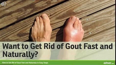 How To Get Rid Of Gout Fast And Naturally In Easy Steps Gout Remedies