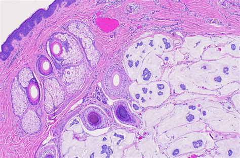 Pathology Outlines Primary Cutaneous Mucinous Carcinoma