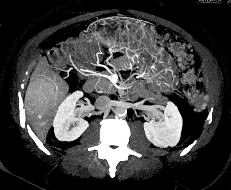Focal Nodular Hyperplasia Fnh Right Lobe Of The Liver Liver Case