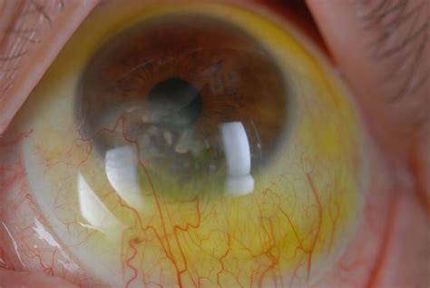 This Patient Has Ocular Cicatricial Pemphigoid An Ocular Manifestation