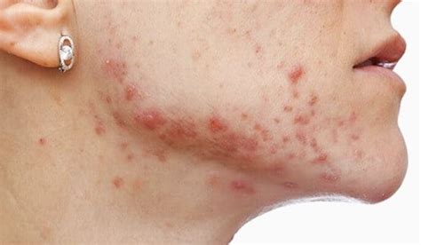 How To Get Rid Of Fungal Acne Sw Learning