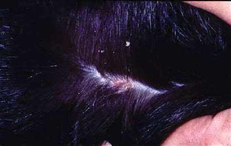 Whats Eating You Cheyletiella Mites Mdedge Dermatology