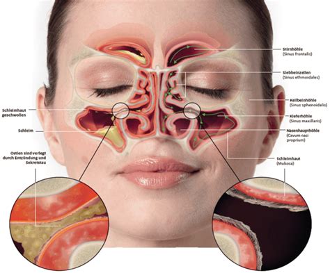 Nasennebenhöhlenentzündung (Sinusitis) | Sinupret® eXtract