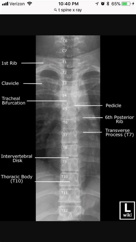 Ap Thoracic Spine Xray Radiology Student Medical Anatomy Radiology