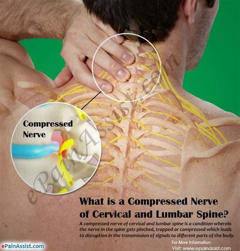 What Is A Compressed Nerve Of Cervical And Lumbar Spine Cervical Spinal Stenosis Cervical
