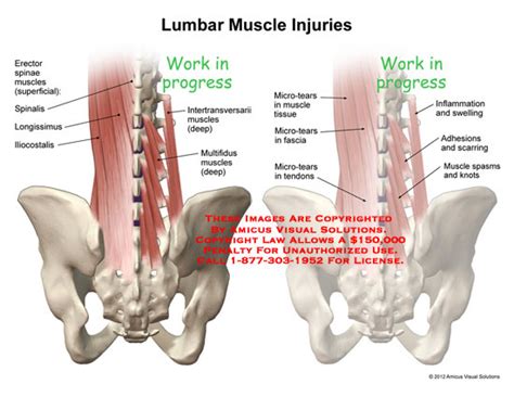 AMICUS Illustration Of Amicus Injury Lumbar Muscles Injuries Erector
