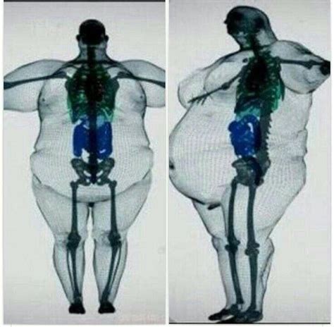 Obesity Scan With Images Body Anatomy Human Body Anatomy