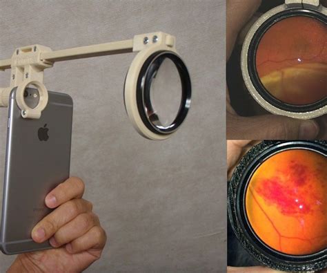 Smartphone Ophthalmoscope Odocs Fundus 3 Steps With Pictures
