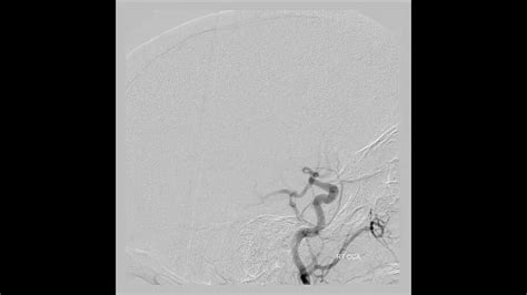 Occluded Mca Mra Angio Angiogram Youtube