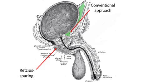 Prostatectomy Diagram
