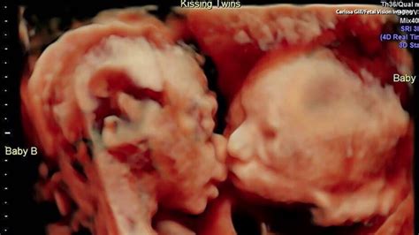 Ultrasound Captures Sweet Moment Between Twins In The Womb Youtube