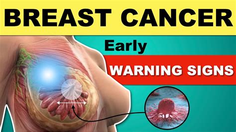 Breast Cancer Symptoms Early Warning Signs Of Breast Cancer Breast Examination Youtube