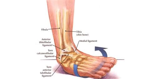 Ankle Sprains Symptoms Treatments And Prevention Watsonia Podiatry