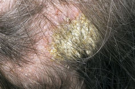 Infected Eczema On The Scalp Stock Image C0083609 Science Photo