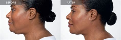 Kybella Double Chin Treatment In Irvine And Orange County Oc Medderm