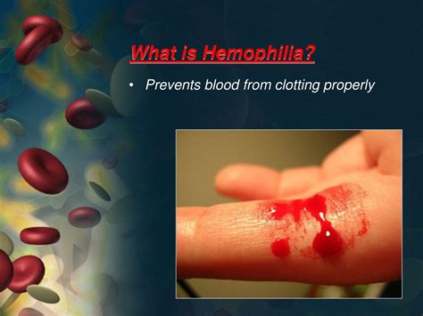 ppt hemophilia powerpoint presentation free download id 6887267
