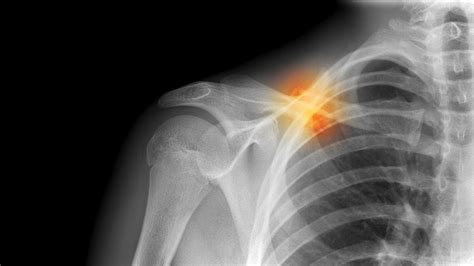 Collarbone Pain Causes Symptoms And Treatment