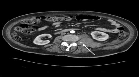 Retroperitoneal Hematoma After Spinal Anesthesia With The Pa