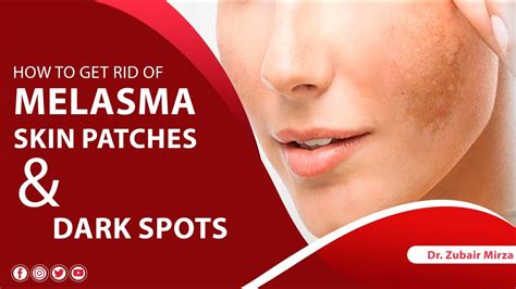 How To Get Rid Of Melasma Skin Dark Patches And Dark Spots Tips For Dark Spots And Melasma