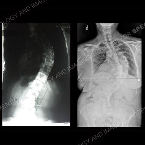 Scoliosis In Adults An Overview Hss