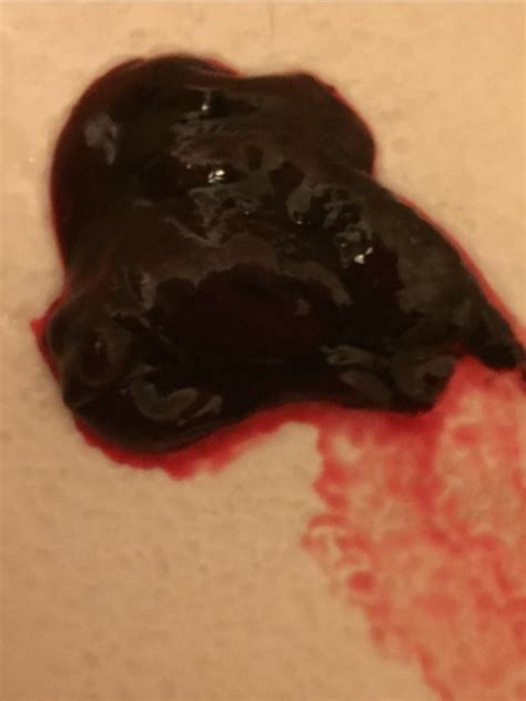 Jelly Like Blood Clots In Period Blood