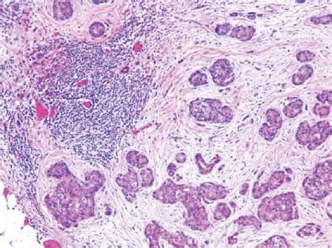 Tumor Metastases In Lymph Nodes Basicmedical Key