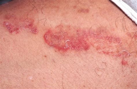 tinea cruris definition causes symptoms and over the counter treatment