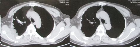 Malignant Giant Cell Tumor Of The Rib With Lung Metastasis In A Man