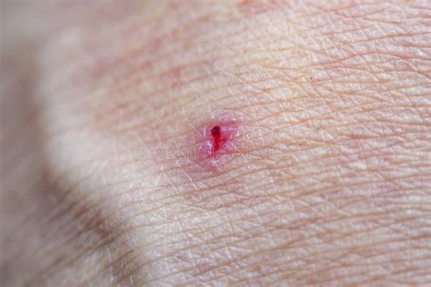 A Close Up Of A Dried Wound On Human Skin Stock Photo Image Of Health