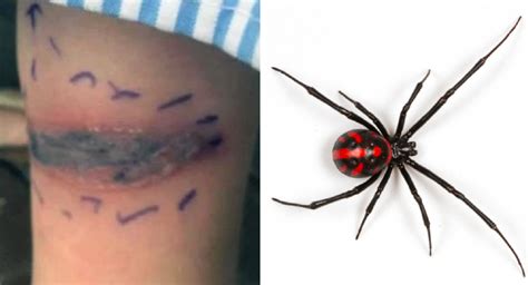 Black Widow Spider Bite Pictures Pic Nugget