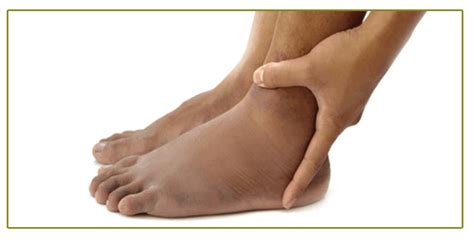 Leg Swelling And Skin Discoloration Leg Pain Specialist