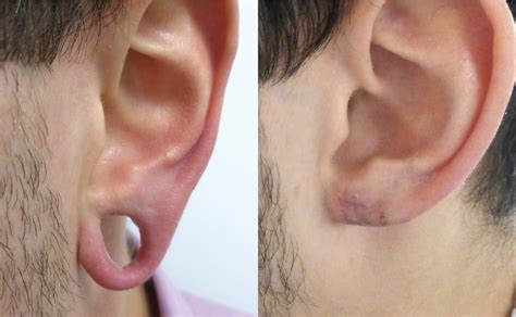 Stretched Earlobe Reconstruction Leeds Skin Surgery Clinic £740
