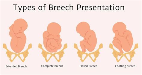 Breech Definition Types Of Breech Presentation Breech Birth Defects