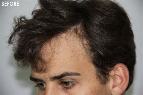 In addition to the many shampoos, conditioners and hair loss products, flattering haircuts and hairstyles can make a world of difference when it comes to hair loss. Right Temple Recession | Hair restoration, Hair, Beverly