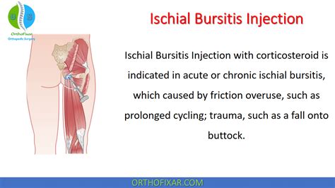 Ischial Bursitis Injection Easy Tutorial Artofit