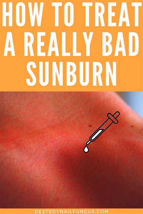 How To Sooth Your Skin With Home Remedies For Sunburn
