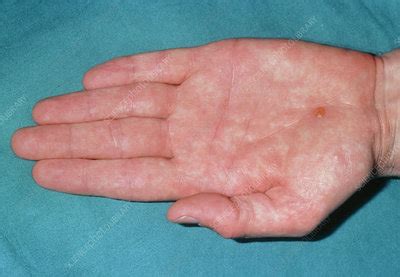 Mild Form Of Pompholyx Eczema Over The Palm Stock Image M