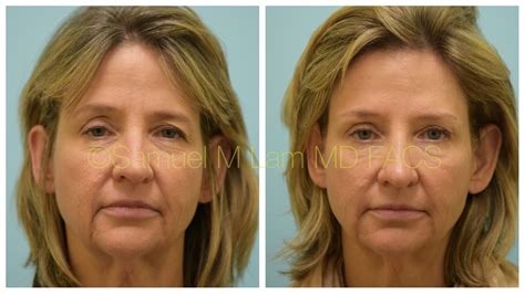 This 56 Year Old Woman Had Fillers And Botox For The First Time And Is Shown Before And Two